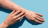 پاکستان میں منکی پاکس کا ایک اور کیس سامنے آگیا
