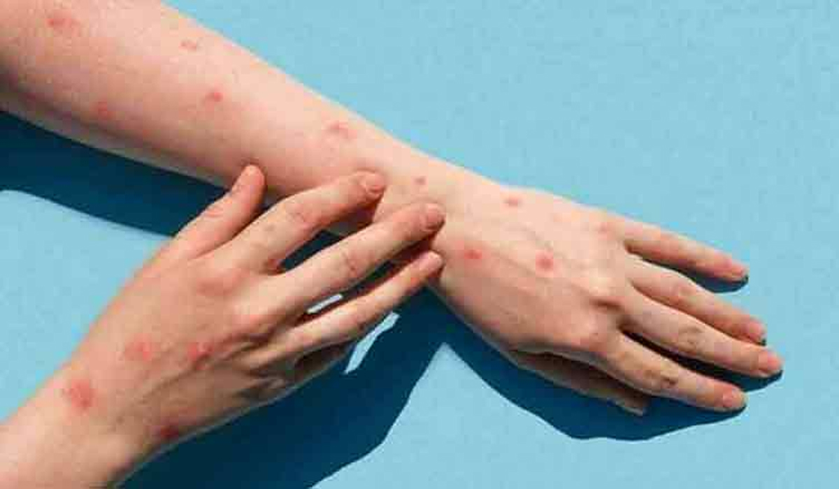پاکستان میں منکی پاکس کا ایک اور کیس سامنے آگیا