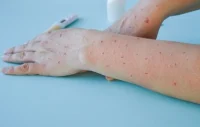 منکی پاکس میں مبتلا 3 رکنی پاکستانی  فیملی ایران میں قرنطینہ